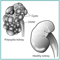 PKD Kidney 3